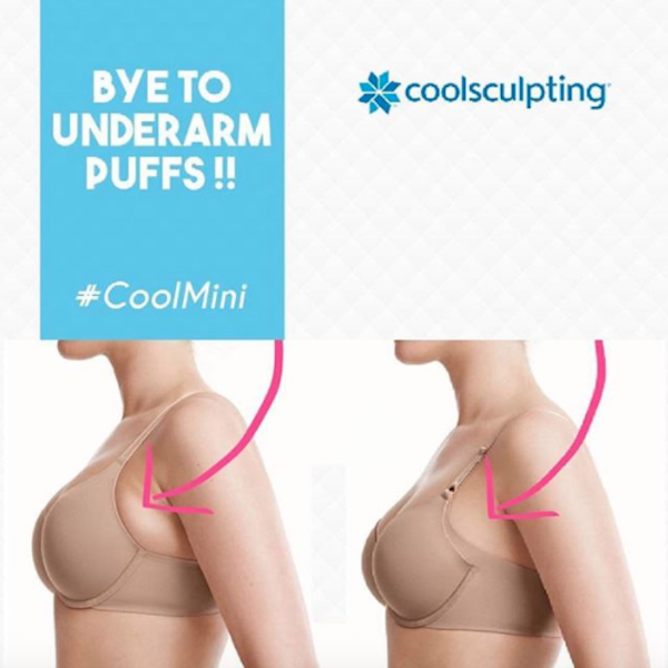 Usir Lemak Secara Instan Tanpa Jarum Pisau Maupun Rasa Sakit Dengan Coolsculpting Soco By Sociolla