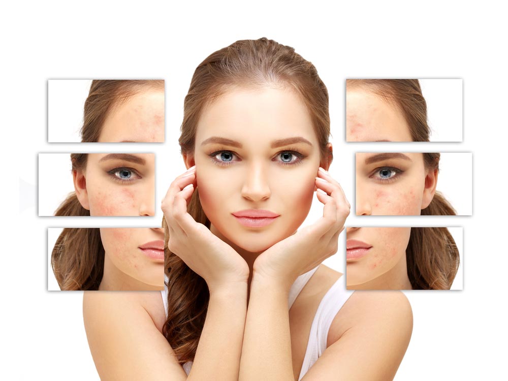 5 Jenis Bekas Jerawat yang Perlu Anda Kenali - Beauty Journal