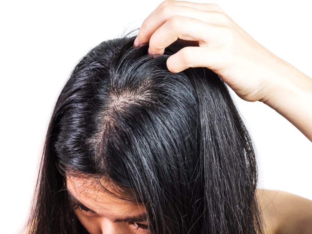 Agar Rambut Tidak Mudah Lepek, Ini Berbagai Penyebab Kulit Kepala